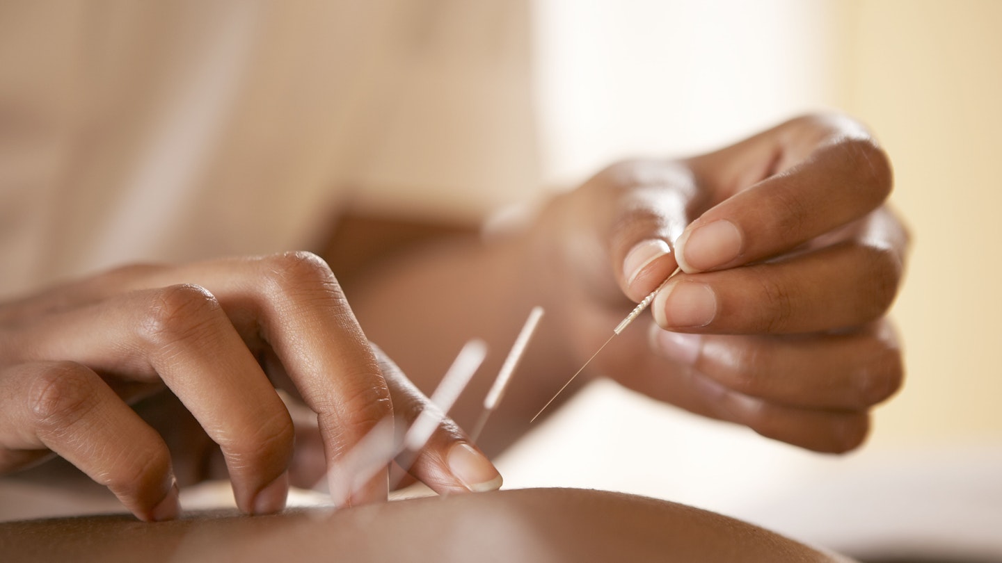 acupuncture for fertility