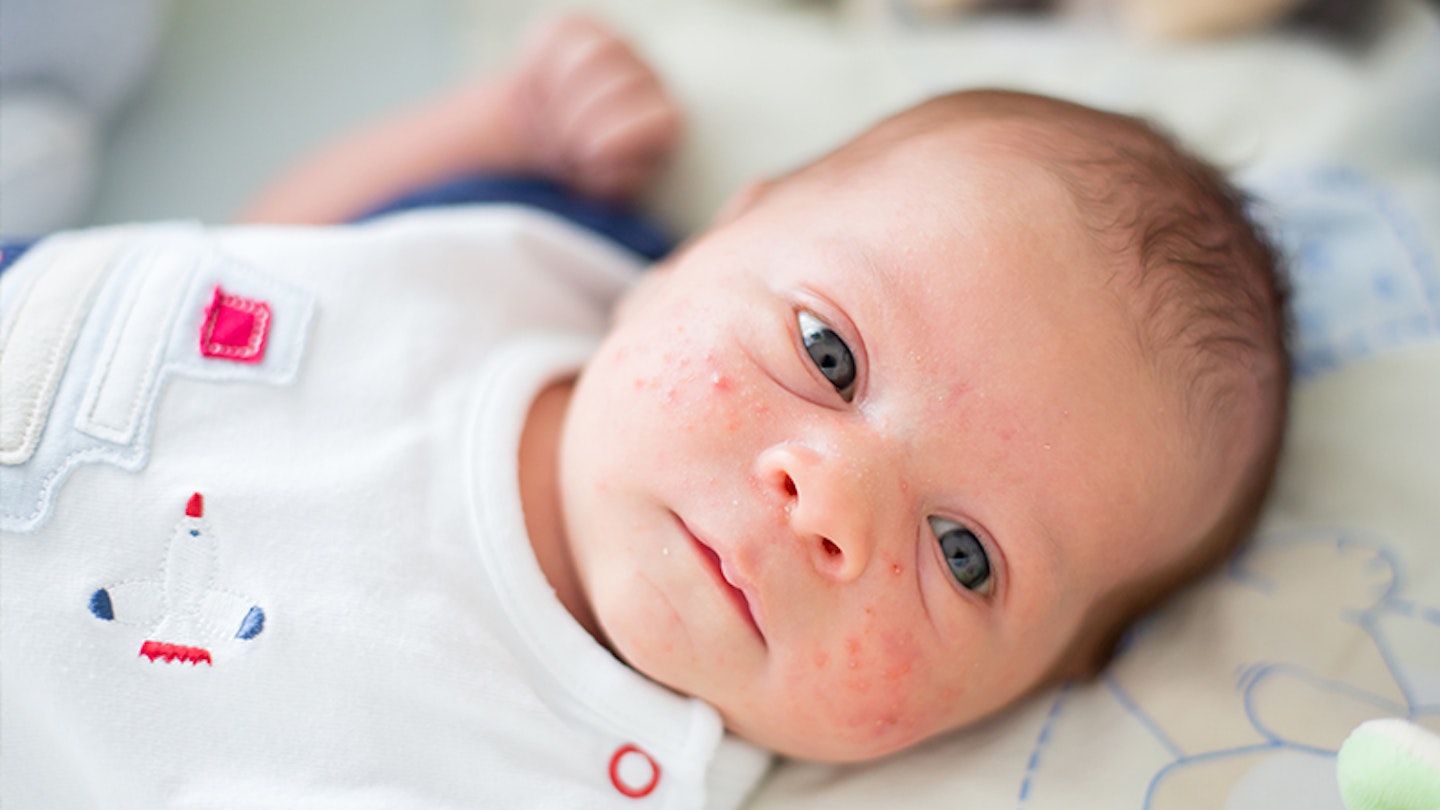 baby acne