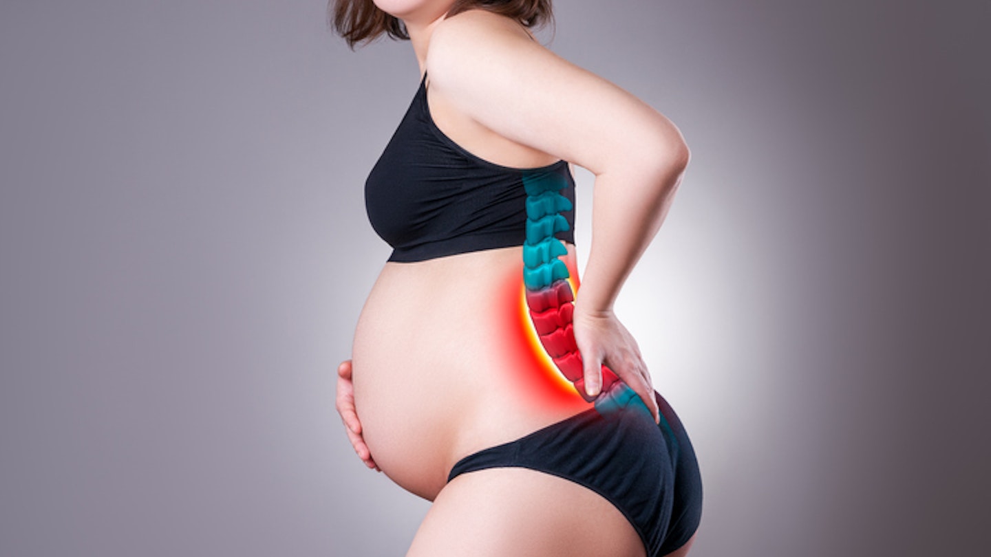 Sciatica in pregnancy