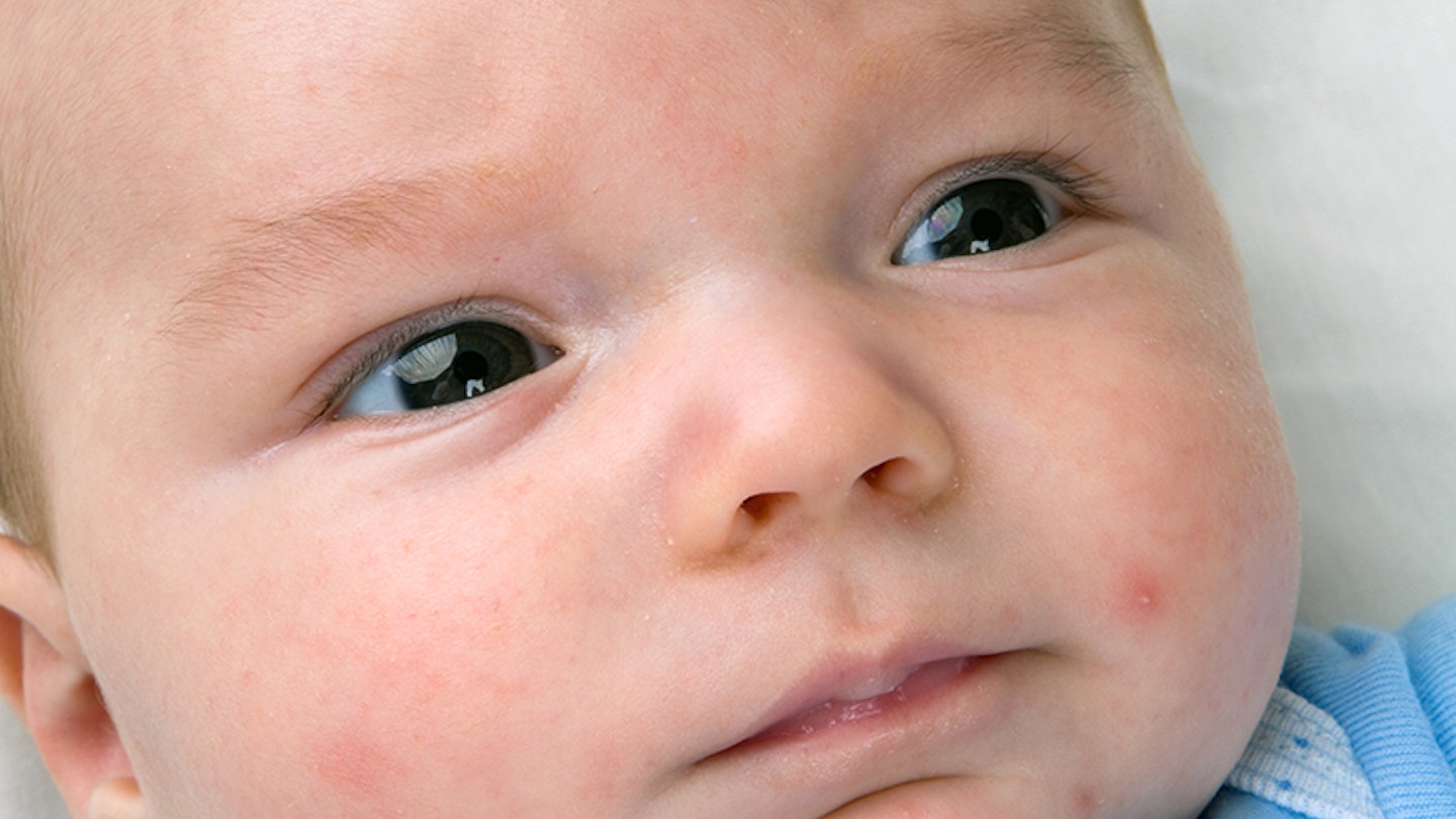 baby rashes